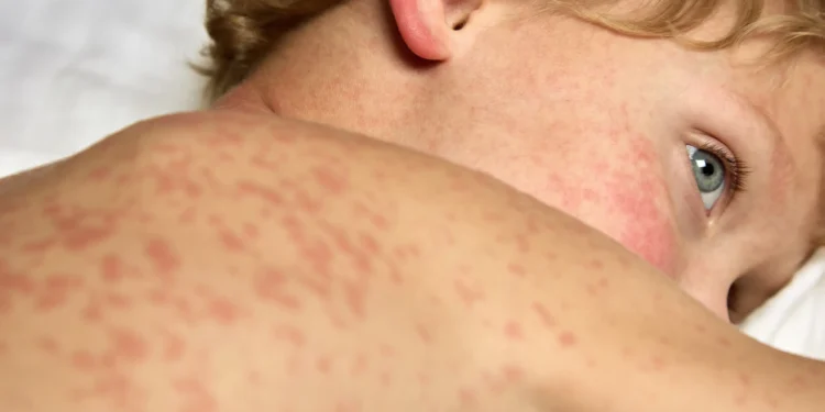 കാനഡയിൽ Measles വ്യാപനം ആശങ്ക ഉയർത്തുന്നു