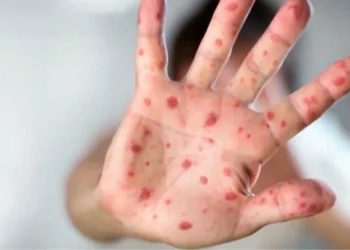 നിപ്പിസിങ് ജില്ലയിൽ നാല് പുതിയ അഞ്ചാം പനി കേസുകൾ സ്ഥിരീകരിച്ചു