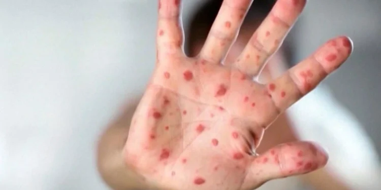 നിപ്പിസിങ് ജില്ലയിൽ നാല് പുതിയ അഞ്ചാം പനി കേസുകൾ സ്ഥിരീകരിച്ചു