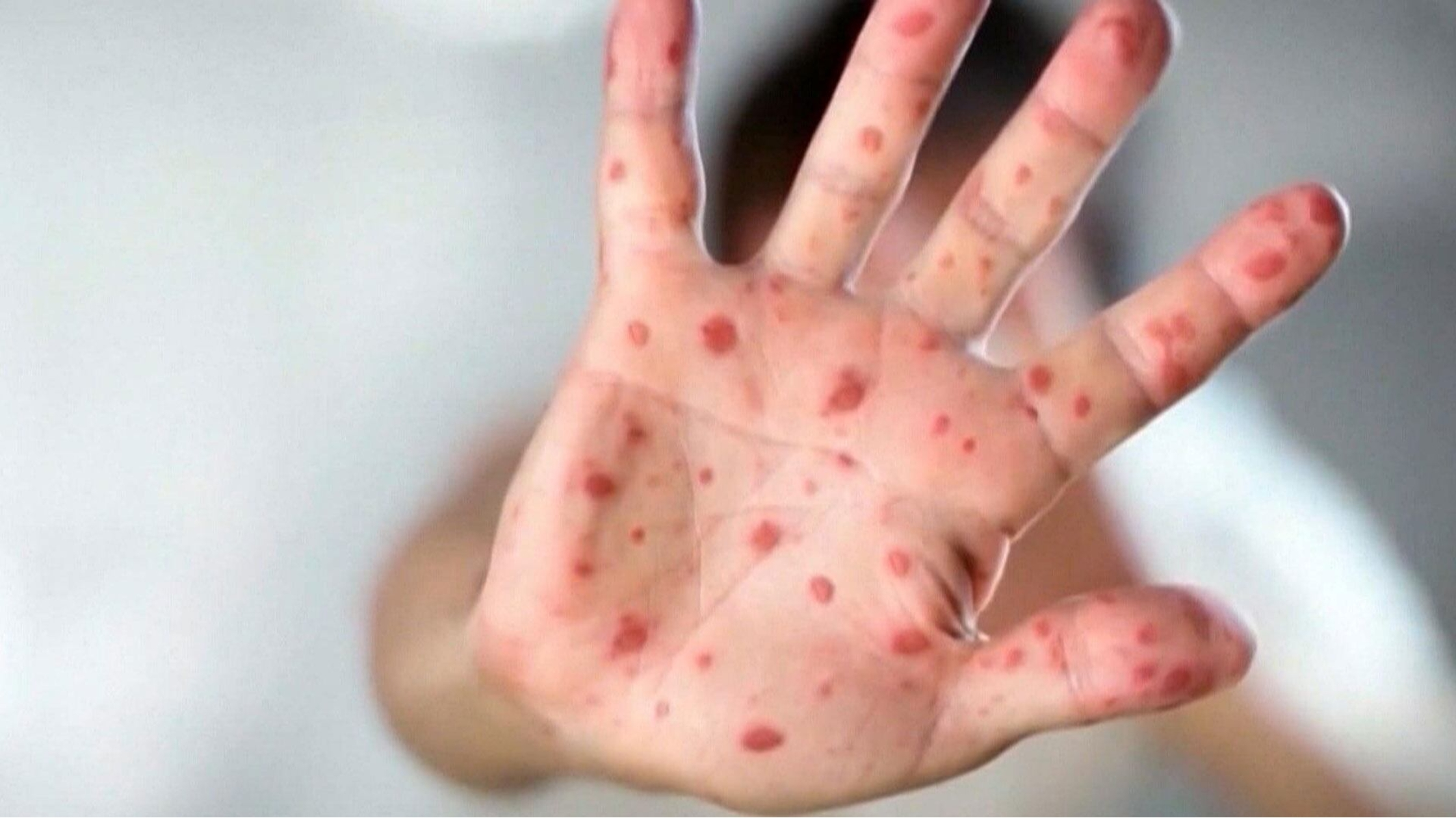 നിപ്പിസിങ് ജില്ലയിൽ നാല് പുതിയ അഞ്ചാം പനി കേസുകൾ സ്ഥിരീകരിച്ചു