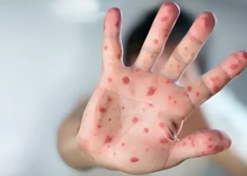 മീസൽസ് ഭീഷണി ഉയരുന്നു;