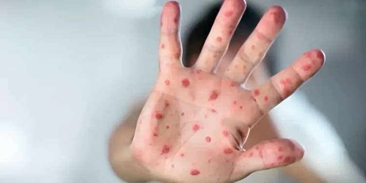 മീസൽസ് ഭീഷണി ഉയരുന്നു; 1 മീസൽസ് ഭീഷണി ഉയരുന്നു;