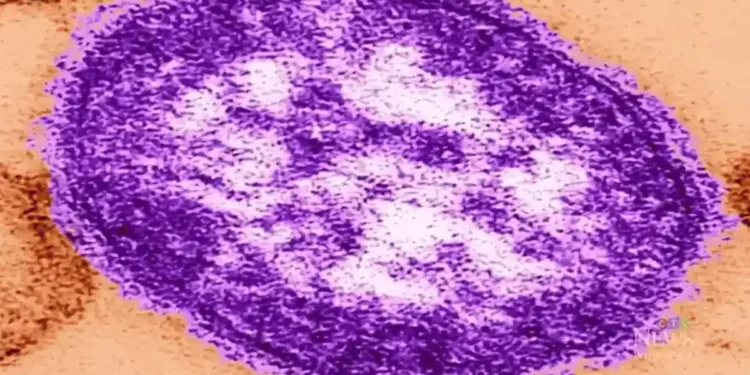 എഡ്മണ്ടനിൽ രണ്ട് മീസിൽസ് കേസുകൾ റിപ്പോർട്ട് ചെയ്തു 1 എഡ്മണ്ടനിൽ രണ്ട് മീസിൽസ് കേസുകൾ റിപ്പോർട്ട് ചെയ്തു