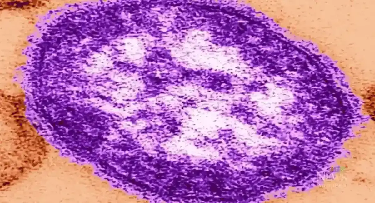 എഡ്മണ്ടനിൽ രണ്ട് മീസിൽസ് കേസുകൾ റിപ്പോർട്ട് ചെയ്തു