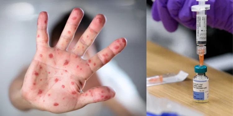 ഒന്റാറിയോയിൽ അഞ്ചാംപനി കേസുകൾ 1,000 കവിഞ്ഞു