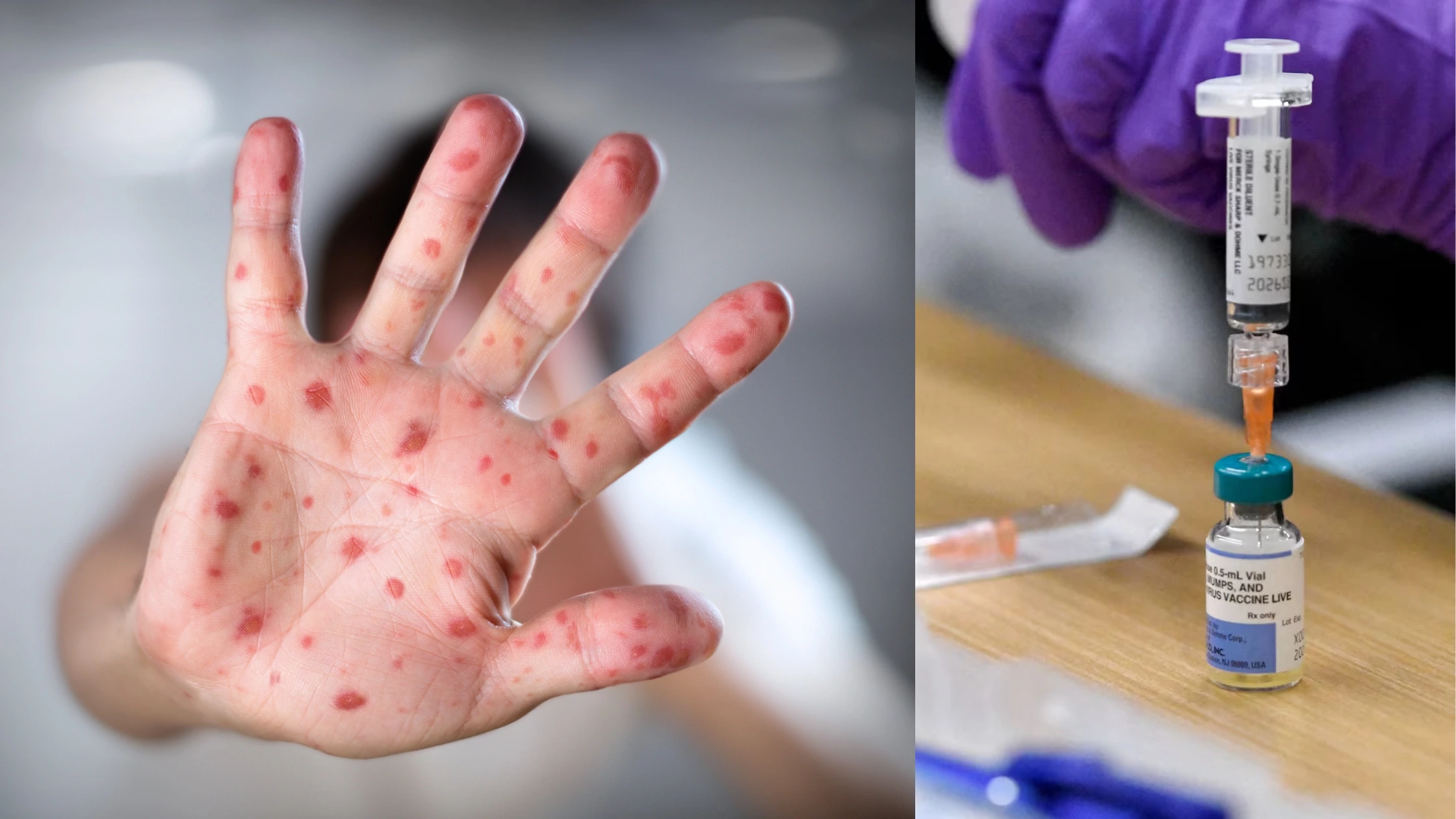 ഒന്റാറിയോയിൽ അഞ്ചാംപനി കേസുകൾ 1,000 കവിഞ്ഞു