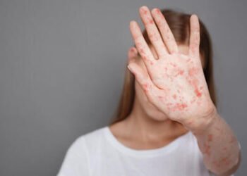 കാനഡയിൽ മീസിൽസ് വ്യാപനം; ഈ സ്ഥലങ്ങളിൽ പോയിട്ടുണ്ടോ? ജാഗ്രത വേണം 5 കാനഡയിൽ മീസിൽസ് വ്യാപനം; ഈ സ്ഥലങ്ങളിൽ പോയിട്ടുണ്ടോ? ജാഗ്രത വേണം