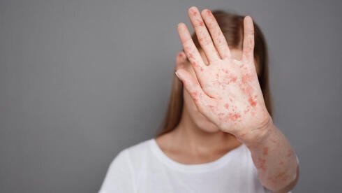 കാനഡയിൽ മീസിൽസ് വ്യാപനം; ഈ സ്ഥലങ്ങളിൽ പോയിട്ടുണ്ടോ? ജാ​ഗ്രത വേണം