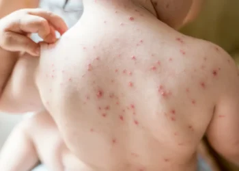 പ്രിൻസ് എഡ്വേർഡ് കൗണ്ടിയിലും ട്രെന്റണിലും പല സ്ഥലങ്ങളിൽ മീസൽസ് വൈറസ് സാന്നിധ്യം: SEHU