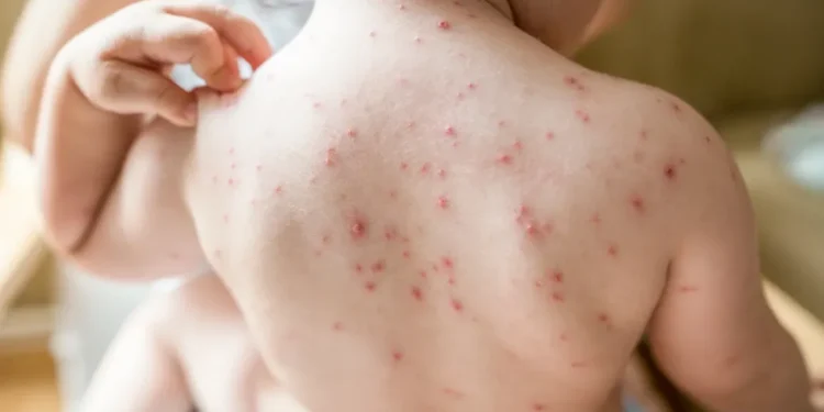 പ്രിൻസ് എഡ്വേർഡ് കൗണ്ടിയിലും ട്രെന്റണിലും പല സ്ഥലങ്ങളിൽ മീസൽസ് വൈറസ് സാന്നിധ്യം: SEHU