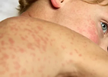 മീസിൽസ് പിടിമുറുക്കുന്നു! ഒന്റാറിയോയിൽ രോഗബാധിതർ 1,000 കവിഞ്ഞു; 7 മീസിൽസ് പിടിമുറുക്കുന്നു! ഒന്റാറിയോയിൽ രോഗബാധിതർ 1,000 കവിഞ്ഞു;