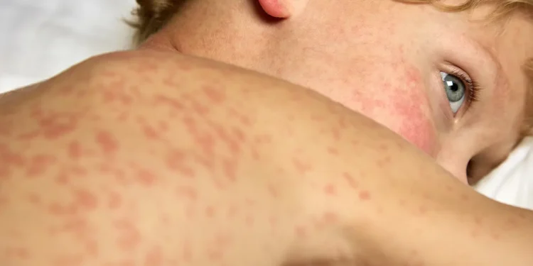 മീസിൽസ് പിടിമുറുക്കുന്നു! ഒന്റാറിയോയിൽ രോഗബാധിതർ 1,000 കവിഞ്ഞു;