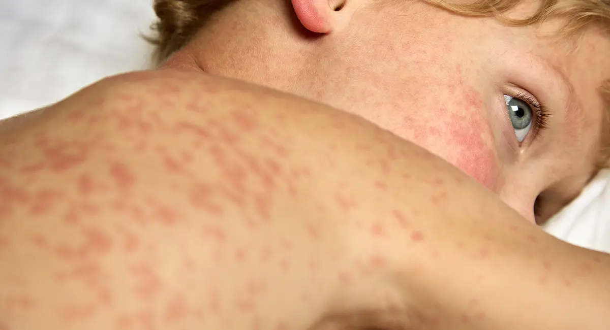 മീസിൽസ് പിടിമുറുക്കുന്നു! ഒന്റാറിയോയിൽ രോഗബാധിതർ 1,000 കവിഞ്ഞു;