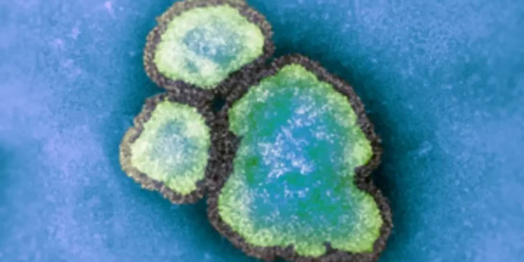 മീസിൽസ് കേസുകൾ 800 കടന്നു 1 മീസിൽസ് കേസുകൾ 800 കടന്നു