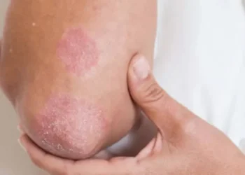 Fungal രോഗങ്ങളുടെ ചികിത്സാപ്രതിരോധം: ആഗോള ആരോഗ്യ ഭീഷണിയെക്കുറിച്ച് WHO മുന്നറിയിപ്പ് നൽകുന്നു 1 Fungal രോഗങ്ങളുടെ ചികിത്സാപ്രതിരോധം: ആഗോള ആരോഗ്യ ഭീഷണിയെക്കുറിച്ച് WHO മുന്നറിയിപ്പ് നൽകുന്നു