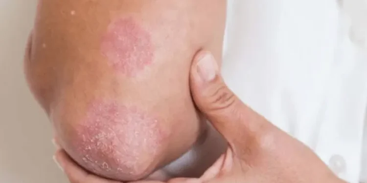 Fungal രോഗങ്ങളുടെ ചികിത്സാപ്രതിരോധം: ആഗോള ആരോഗ്യ ഭീഷണിയെക്കുറിച്ച് WHO മുന്നറിയിപ്പ് നൽകുന്നു