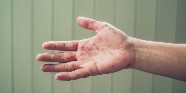 ഓന്റാരിയോയിൽ മീസിൽസ് ബാധിച്ച് കുഞ്ഞ് മരിച്ചു; നിലവിലെ പകർച്ചവ്യാധിയിലെ ആദ്യ മരണം