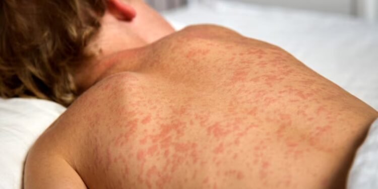 പിടിമുറുക്കി മീസിൽസ്: ഏട്ട് കുഞ്ഞുങ്ങൾക്ക് അടിയന്തിര പ്രതിരോധ മരുന്ന് നൽകും! 1 പിടിമുറുക്കി മീസിൽസ്: ഏട്ട് കുഞ്ഞുങ്ങൾക്ക് അടിയന്തിര പ്രതിരോധ മരുന്ന് നൽകും!