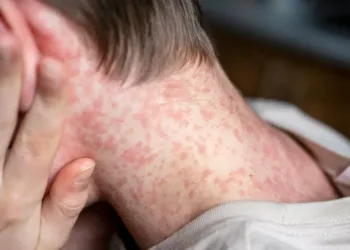 ആൽബർട്ടയിൽ മീസിൽസ് രോഗികളുടെ എണ്ണം 1000 കടന്നു; മുന്നറിയിപ്പുമായി ആരോഗ്യപ്രവർത്തകർ