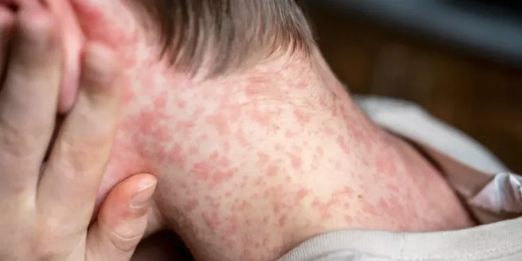 ആൽബർട്ടയിൽ മീസിൽസ് രോഗികളുടെ എണ്ണം 1000 കടന്നു; മുന്നറിയിപ്പുമായി ആരോഗ്യപ്രവർത്തകർ