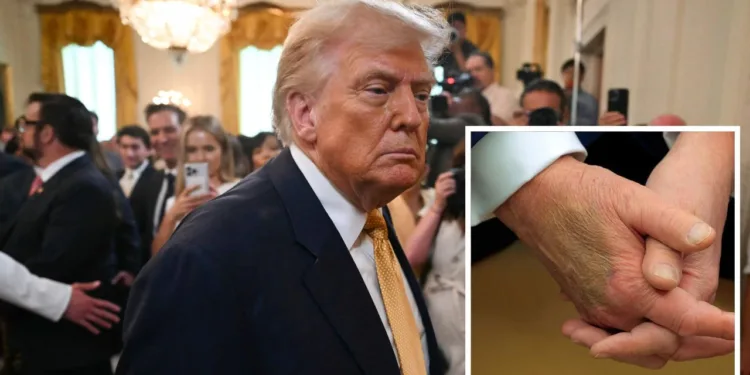 ട്രംപിന് ക്രോണിക് വെനസ് ഇൻസഫിഷ്യൻസി രോഗം; അഭ്യൂഹങ്ങൾക്ക് വിരാമമിട്ട് വൈറ്റ് ഹൗസ്