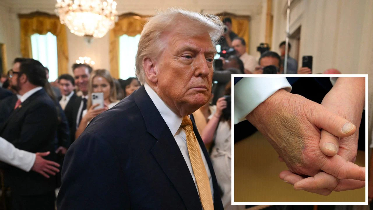 ട്രംപിന് ക്രോണിക് വെനസ് ഇൻസഫിഷ്യൻസി രോഗം; അഭ്യൂഹങ്ങൾക്ക് വിരാമമിട്ട് വൈറ്റ് ഹൗസ്