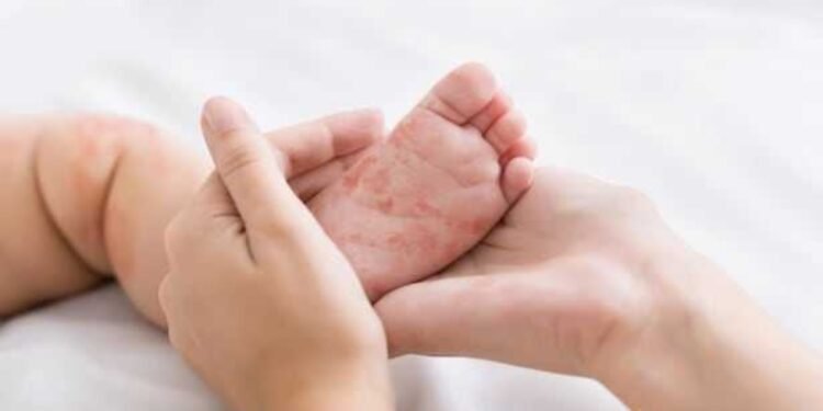 അഞ്ചാംപനി ഭീതിയിൽ ഹാമിൽട്ടൺ: കോസ്റ്റ്‌കോ, സർവീസ് ഒന്റാറിയോ എന്നിവിടങ്ങളിൽ ജാഗ്രതാ നിർദ്ദേശം