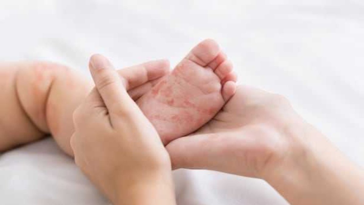 അഞ്ചാംപനി ഭീതിയിൽ ഹാമിൽട്ടൺ: കോസ്റ്റ്‌കോ, സർവീസ് ഒന്റാറിയോ എന്നിവിടങ്ങളിൽ ജാഗ്രതാ നിർദ്ദേശം