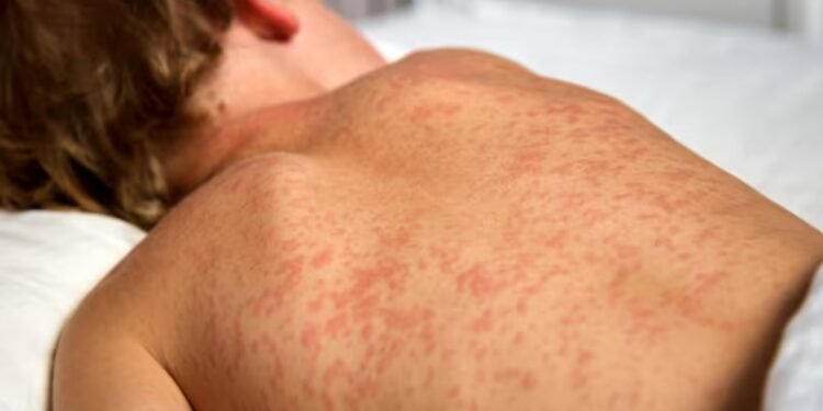 നോവ സ്കോഷ്യയിൽ അഞ്ചാംപനി ബാധിച്ചവരുടെ എണ്ണം 35 ആയി; രണ്ട് സമ്പർക്ക മേഖലകൾ കൂടി കണ്ടെത്തി 1 meals