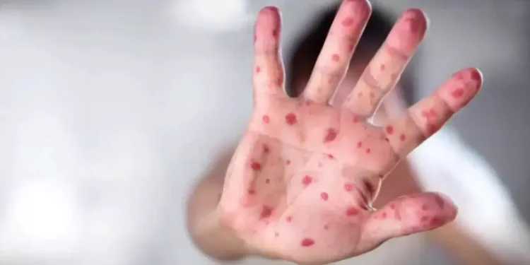 ഒന്റാറിയോയിൽ മീസിൽസ് ആശങ്ക: പ്രമുഖ വിനോദസഞ്ചാര കേന്ദ്രത്തിൽ കേസുകൾ കുതിച്ചുയരുന്നു! 1 ഒന്റാറിയോയിൽ മീസിൽസ് ആശങ്ക: പ്രമുഖ വിനോദസഞ്ചാര കേന്ദ്രത്തിൽ കേസുകൾ കുതിച്ചുയരുന്നു!