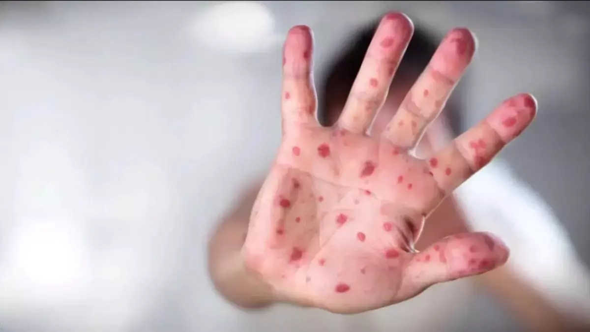 ഒന്റാറിയോയിൽ മീസിൽസ് ആശങ്ക: പ്രമുഖ വിനോദസഞ്ചാര കേന്ദ്രത്തിൽ കേസുകൾ കുതിച്ചുയരുന്നു!