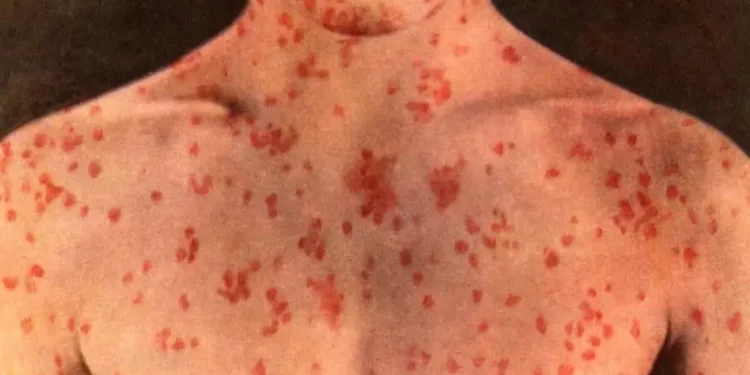 കാനഡയിൽ മീസിൽസ് കുതിച്ചുയരുന്നു: ആൽബെർട്ടയിൽ ആശങ്ക, പ്രതിരോധശേഷി എങ്ങനെ ഉറപ്പാക്കാം?