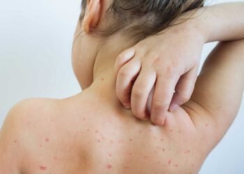 measles