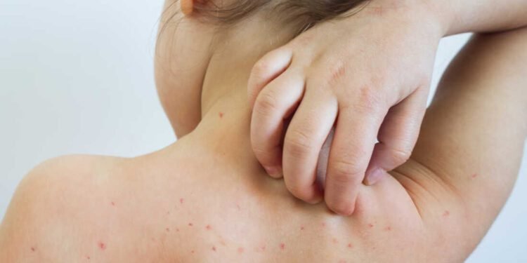 ഈ സ്ഥലങ്ങളിൽ പോയിട്ടുണ്ടോ? ജാഗ്രത വേണമെന്ന് ഹെൽത്ത് അതോറിറ്റി; യോർക്ക്ട്ടണിൽ അഞ്ചാംപനി മുന്നറിയിപ്പ് 1 measles