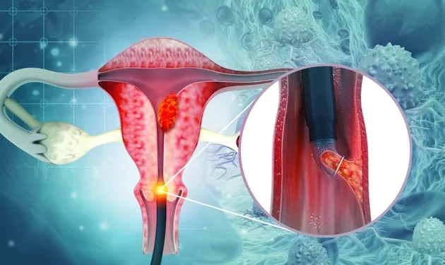 ഗർഭാശയ കാൻസർ; 80% സ്ത്രീകൾക്കും ലക്ഷണങ്ങൾ അറിയില്ല, കാനഡയിൽ നടന്ന പുതിയ സർവേ ഫലം 1 Cervical cancer