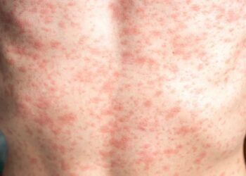 സാസ്കച്ചെവാനിൽ മീസിൽസ് പടരുന്നു; രോഗബാധ കൂടുതലും വാക്സിനെടുക്കാത്തവർക്ക്: കണക്കുകൾ പുറത്ത്