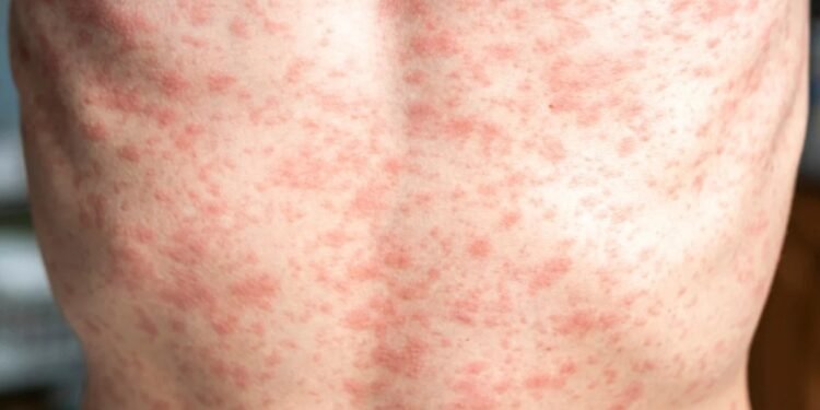 സാസ്കച്ചെവാനിൽ മീസിൽസ് പടരുന്നു; രോഗബാധ കൂടുതലും വാക്സിനെടുക്കാത്തവർക്ക്: കണക്കുകൾ പുറത്ത്