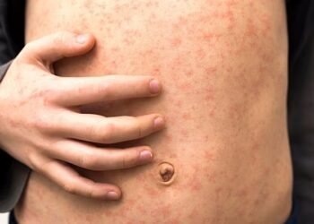 മാനിറ്റോബയിൽ മീസിൽസ് ഭീഷണി: വിൻക്ലറിലെ ഔട്ട്‌പോസ്റ്റ് ഗ്രിൽ സന്ദർശിച്ചവർ ശ്രദ്ധിക്കുക