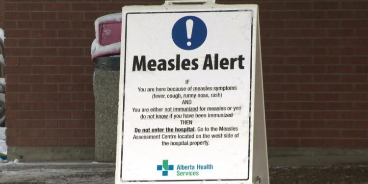 മാനിറ്റോബയിൽ മീസിൽസ് ജാഗ്രതാ നിർദ്ദേശം; സമ്പർക്ക പട്ടിക പുറത്തുവിട്ട് ആരോഗ്യവകുപ്പ്