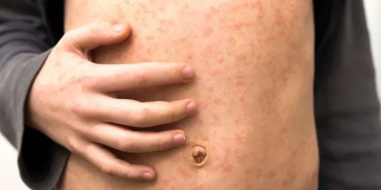 Getty Images Health experts warn measles spreads very easily and can cause serious health complications