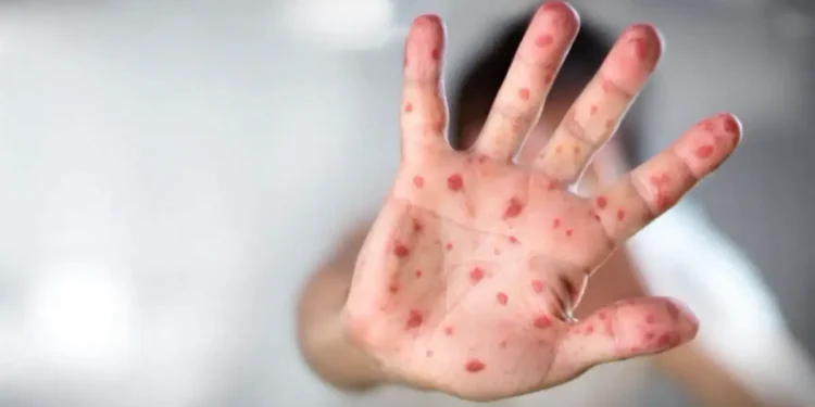 മാനിറ്റോബയിൽ മീസിൽസ് പടരുന്നു; ഒരാഴ്ചയ്ക്കിടെ 44 കേസുകൾ സ്ഥിരീകരിച്ചു 1 hand