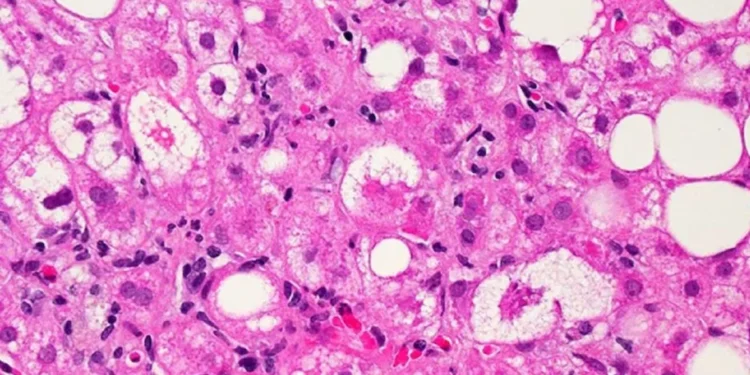 Alberta Hepatitis Treatment